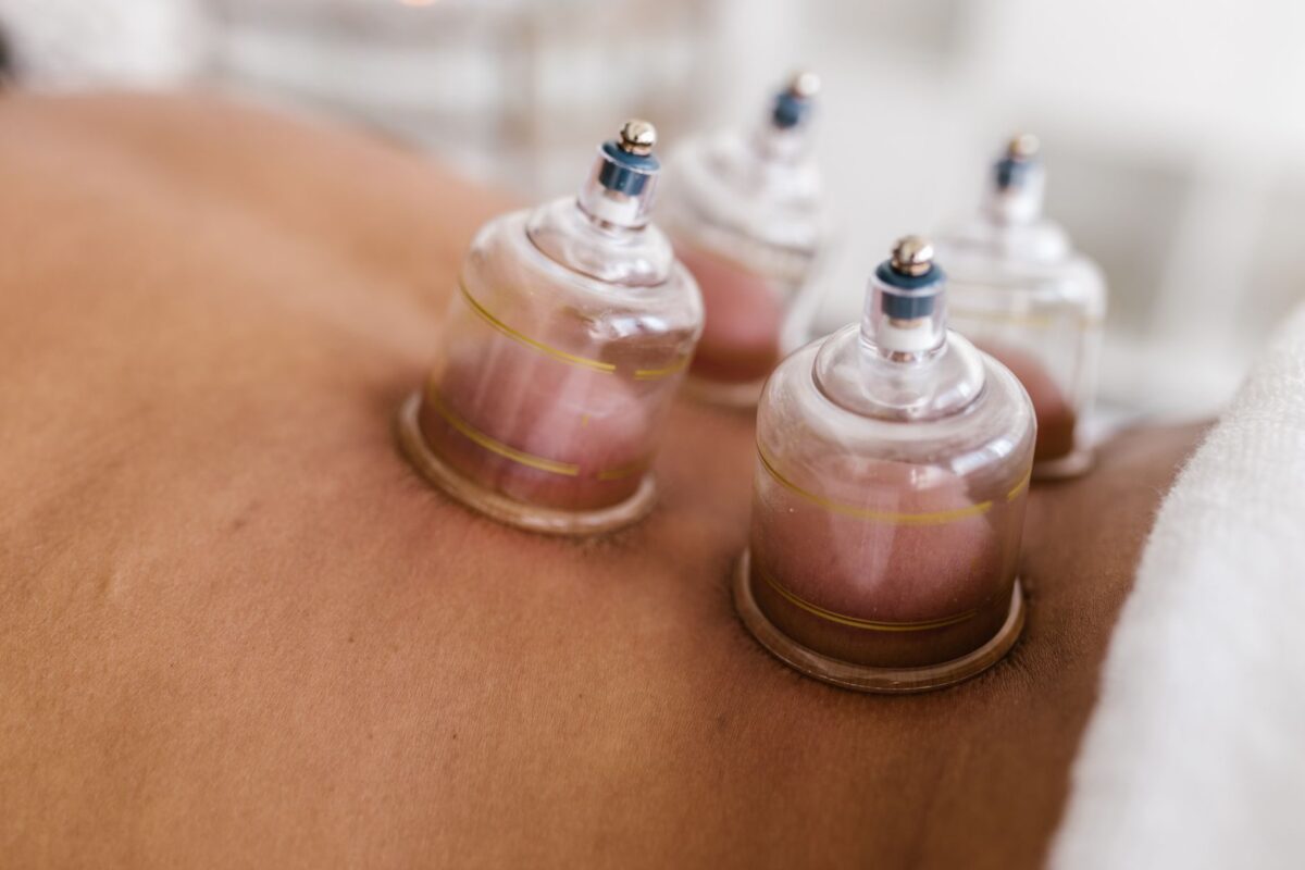 Close-up of glass cupping cups placed on a client's back